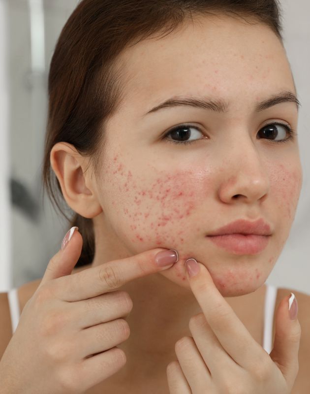 Laser Acne and Pimple Treatment in Delhi